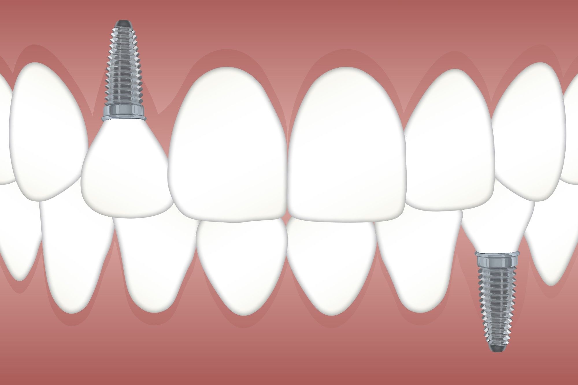 permanent-teeth-replacement-options-dental-implants-gordon-dental