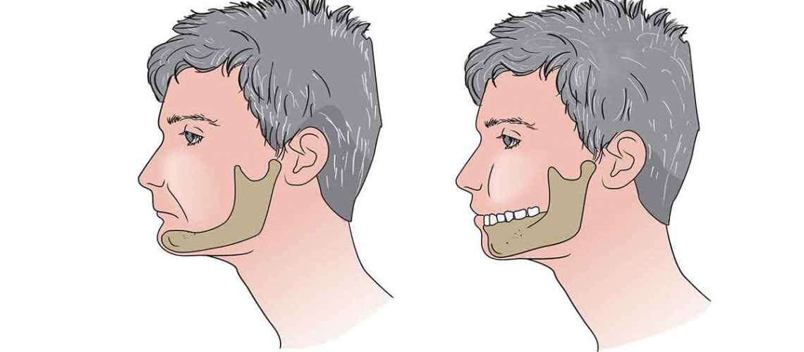 What shape of teeth are best for my face? - Advice for all 5 face shapes